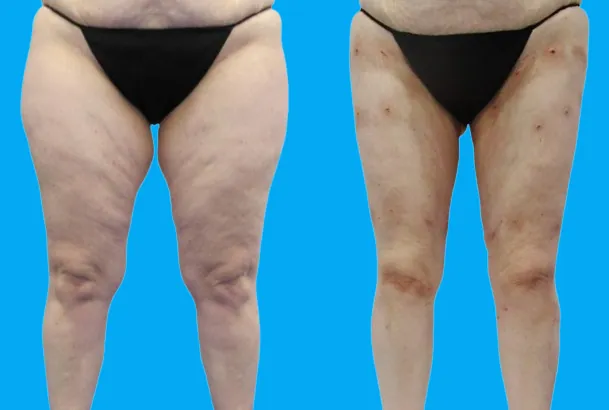 Résultats avant / après lipœdème – photo 2